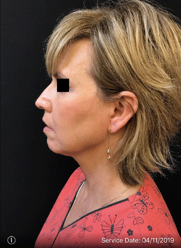 Facetite