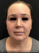 Facetite