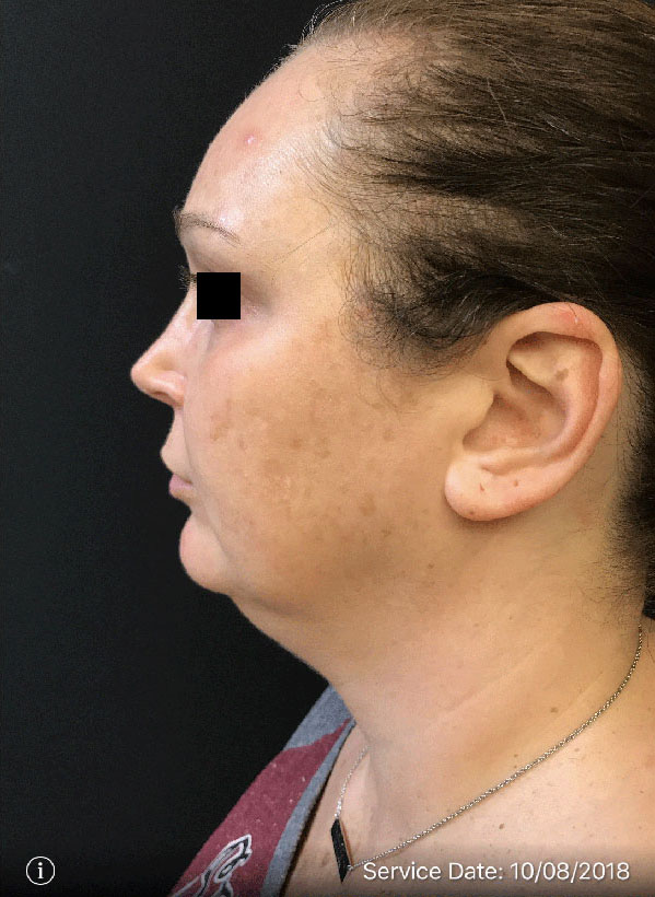 Facetite
