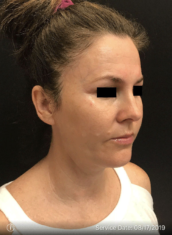 Facetite