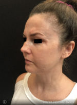 Facetite