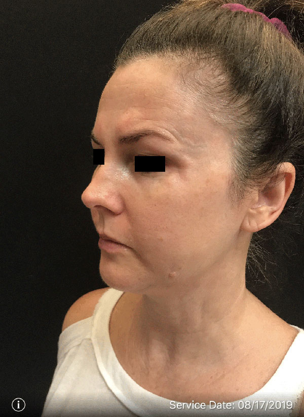 Facetite