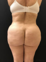 Brazilian Butt Lift