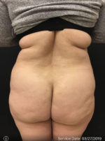 Brazilian Butt Lift