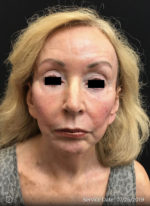 Around The Eye Fillers