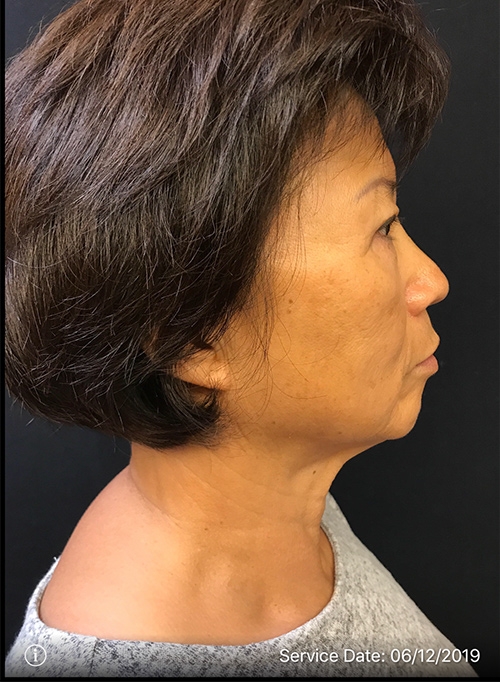 Facelift