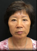 Facelift