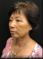 Facelift