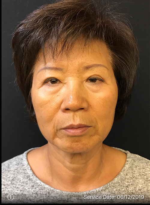 Facelift