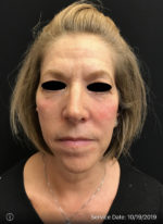 Around The Eye Fillers
