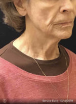 Facelift