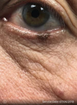 Dysplastic Nevus
