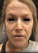 Around The Eye Fillers