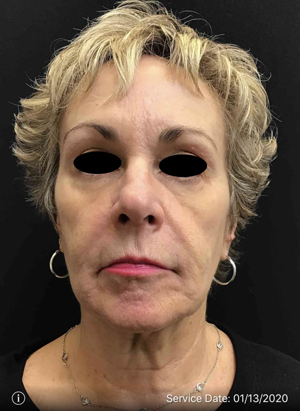 Around The Eye Fillers