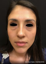 Around The Eye Fillers
