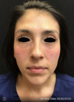 Around The Eye Fillers