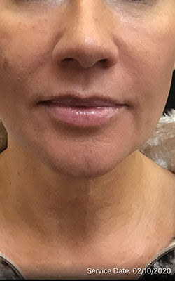 Lip Augmentation