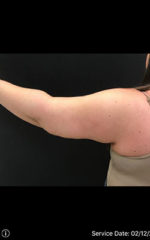 Brachioplasty