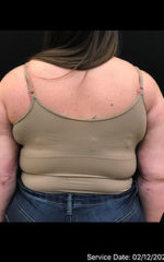 Brachioplasty