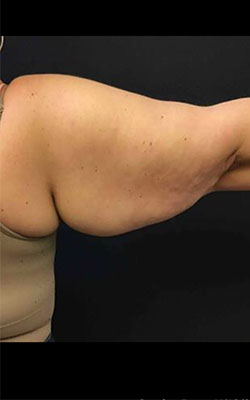 Brachioplasty