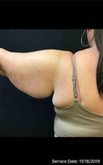 Brachioplasty