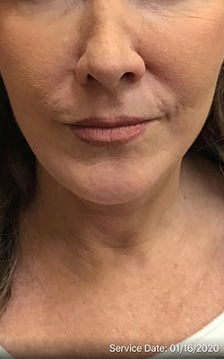 Juvederm