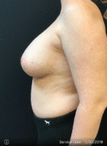 Fat Grafting to Breast