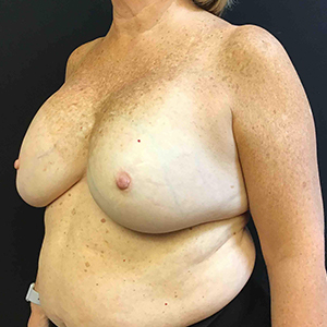Fat Grafting to Breast