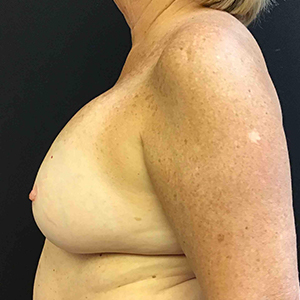 Fat Grafting to Breast