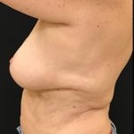 Fat Grafting to Breast