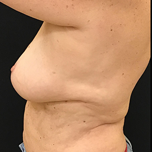 Fat Grafting to Breast