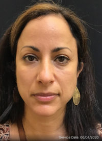 Around The Eye Fillers