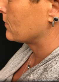Facetite