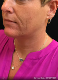 Facetite