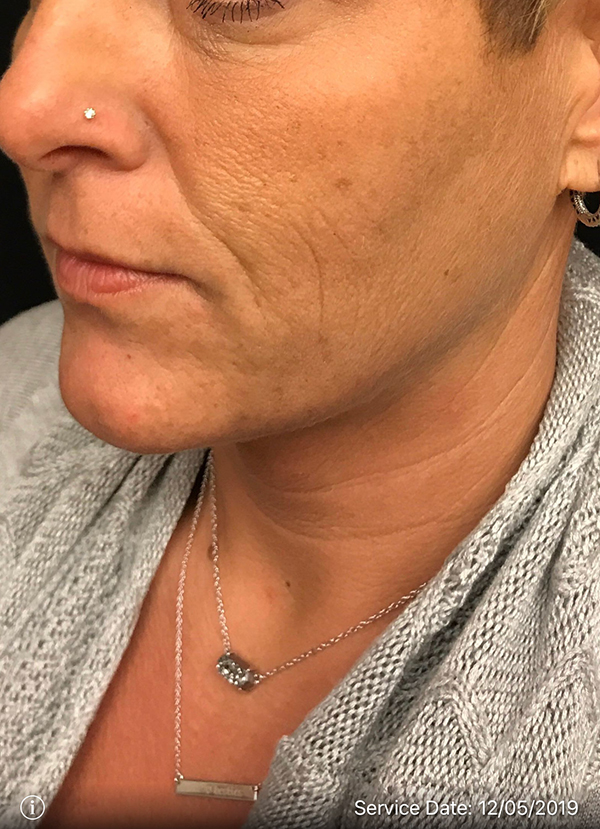Facetite