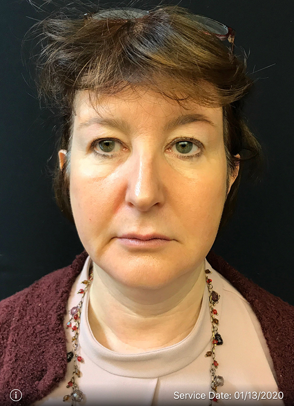 Facetite