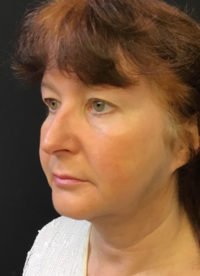 Facetite