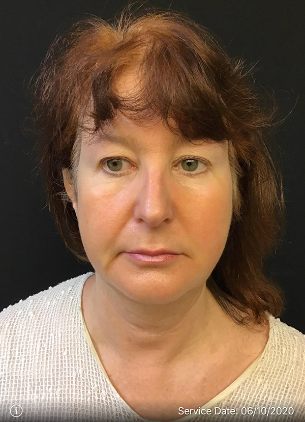 Facetite