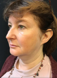 Facetite