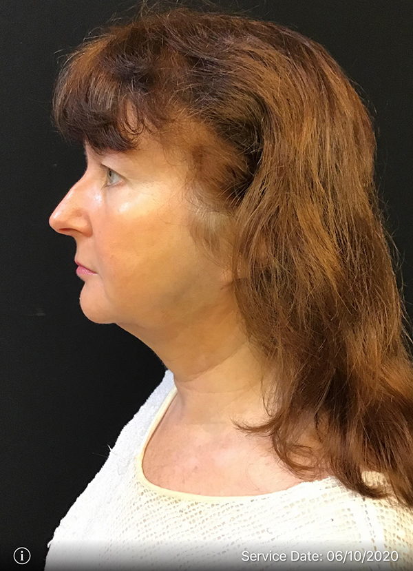 Facetite