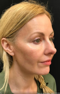 Nose Surgery