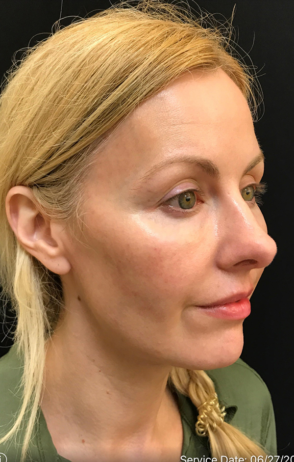 Nose Surgery