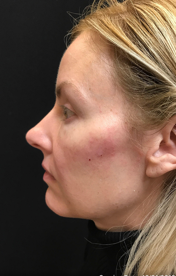 Nose Surgery