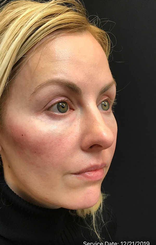 Nose Surgery