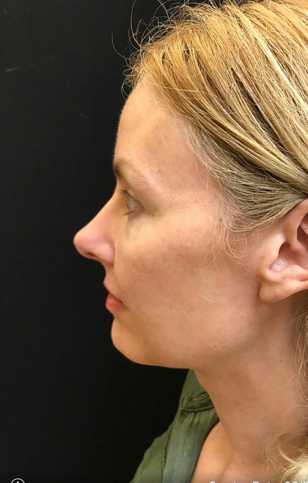 Nose Surgery