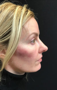 Nose Surgery