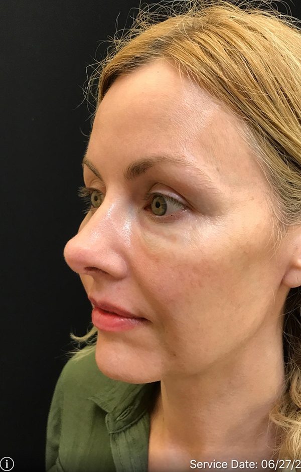 Nose Surgery