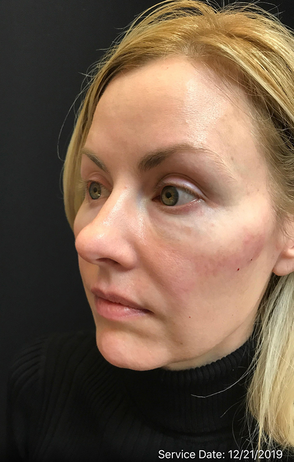 Nose Surgery