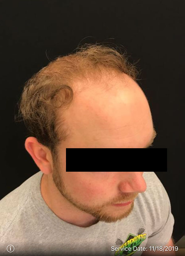 NeoGraft