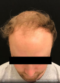 NeoGraft
